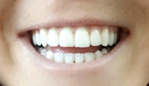 My beautiful teeth!