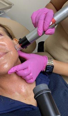 Radio Frequency Microneedling