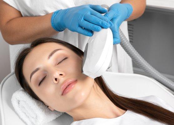 IPL photofacial