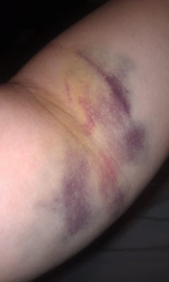 4 days after a donation gone wrong.  I was told my bruising isn't THAT bad...