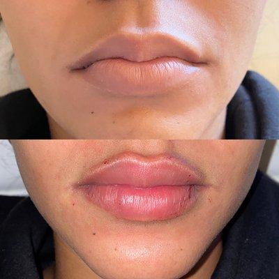 Lip filler