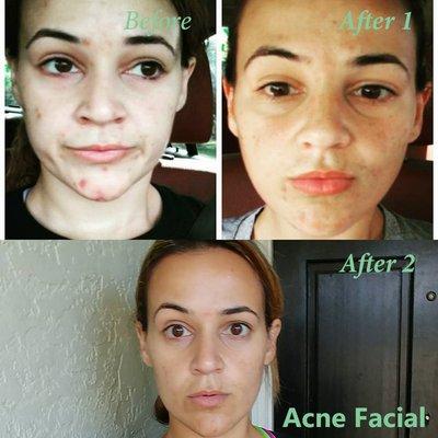 Acne Facial at Anna Esthetics