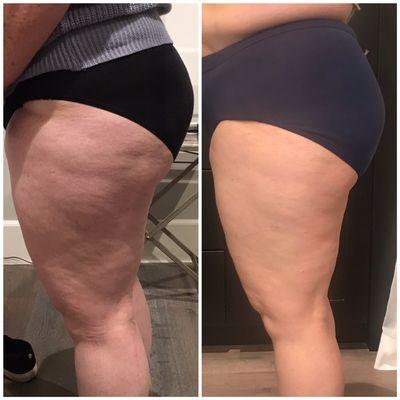 Cellulite reduced after 6 treatments