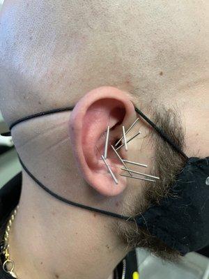 Auricular acupuncture