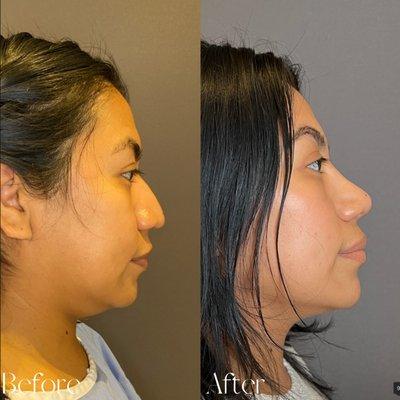 Female 1 Year After Closed Rhinoplasty