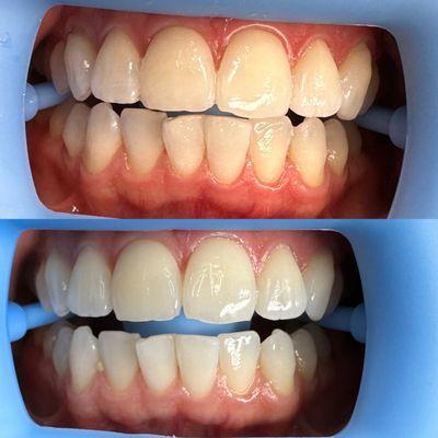 60 Minute Whitening