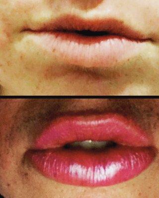 Before and after pics of a client who wanted "dramatic" lips.