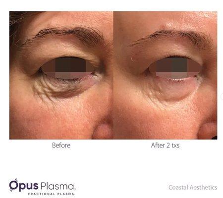 Dramatic results from Opus Plasma Device!