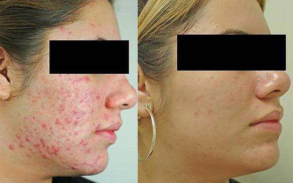 Let us Help you with the Acne and the scaring  top of the line Fotona Laser