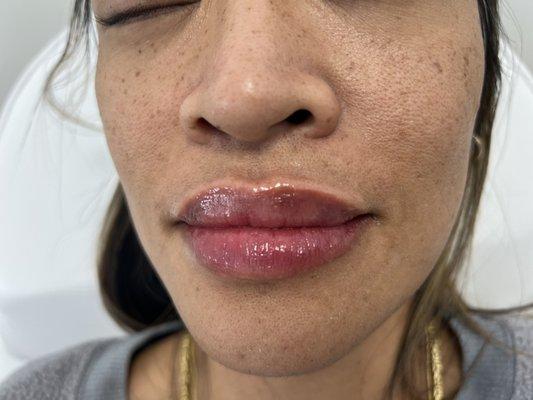 Post Juvederm Lip Filler