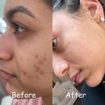 Acne cleared after facial treatments