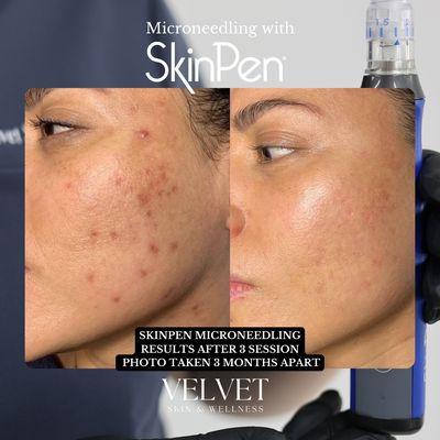 3 months After Microneedling 3 Sessions with SkinPen