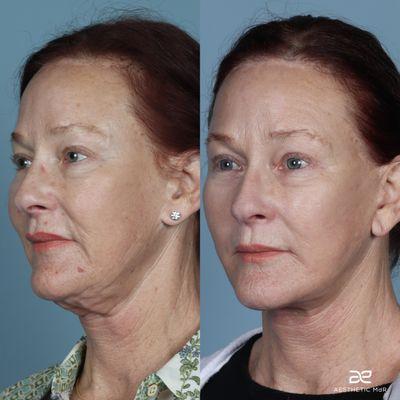 Secondary Facelift, neck lift, blepharoplasty, and fat grafting.