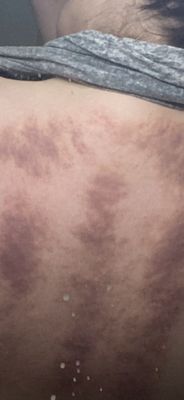 Gua sha, acupressure, Thai massage