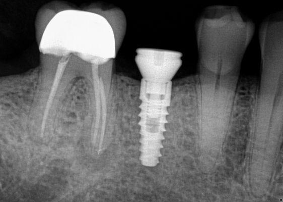 Beautiful dental implant placement