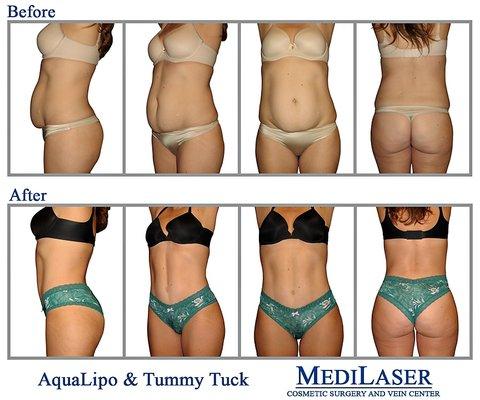 Aqualipo-Lipo-Liposculpture-TUMMY TUCK-Cosmetic-Surgeon-Dr-Giraldo