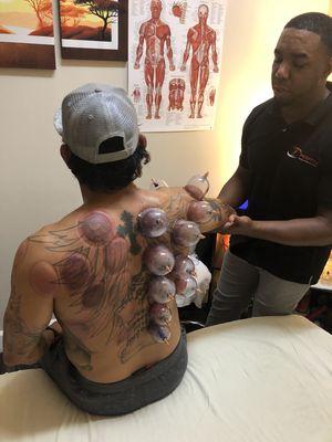 Cupping session for shoulder impingement