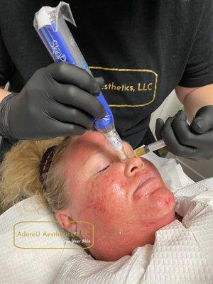 Microneedling with PRP stimulates your body's regeneration system goes into overdrive and you produce collagen and elastin at amazing rates!