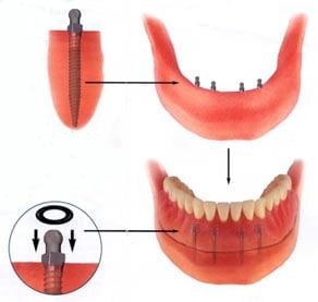 Mini Dental Implants make for Solid dentures.