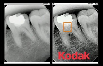 KODAK Digital XRAYS