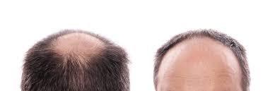 Hair Loss, men