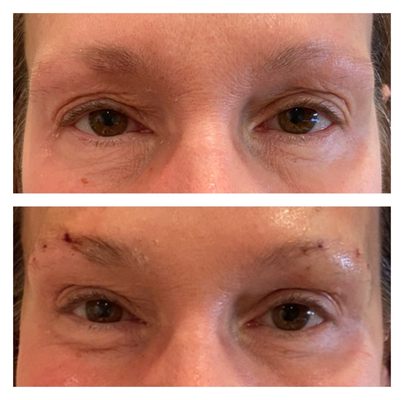 PDO thread brow lift