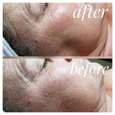 Look at the texture difference along the cheek and around the eye after one Dermaplane Facial!