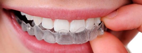 Experts in Invisalign! Ask for Dr. Kellerman for complete perfection.