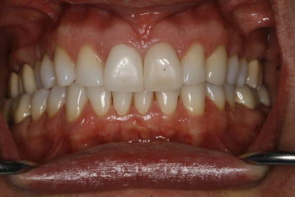 Full view of veneers 8 & 9