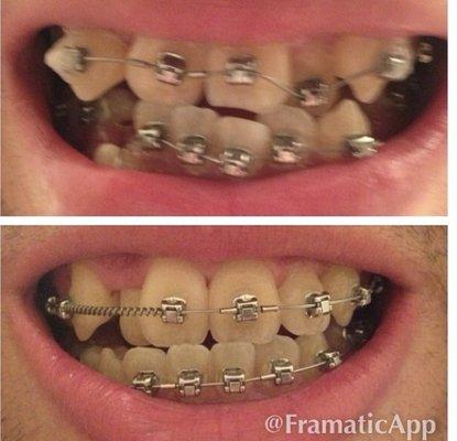 First day in braces on top, bottom photo 6 months into treatment after extractions.