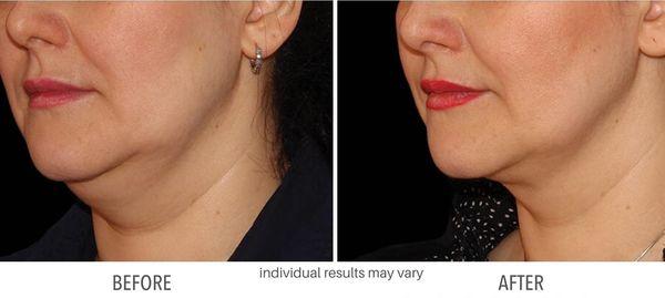 Before & After Neck/Decollette with sculpting methods.