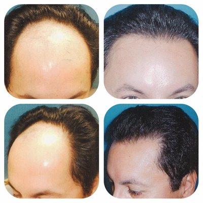 Grade four on NW scale, 2500 grafts using FUT and ultra refined microscopic technique.