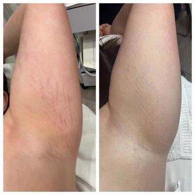 SmartRF treatment for stretch marks. Before & after