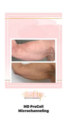 RF skin tightening+ MD ProCell microchanneling