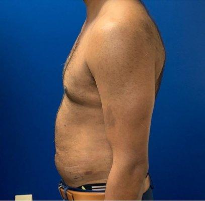 Male liposuction after