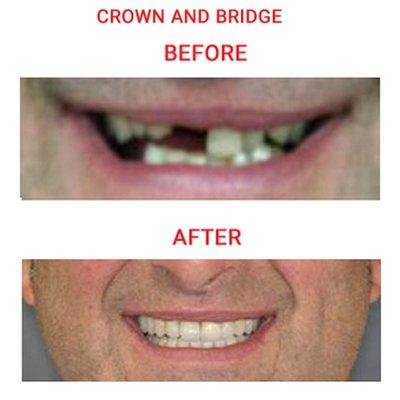 Denture and Implants Carrollton,Texas