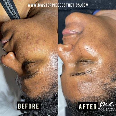 Acne Treatments + Proper Home Care and Consistency and your skin can look like this too!