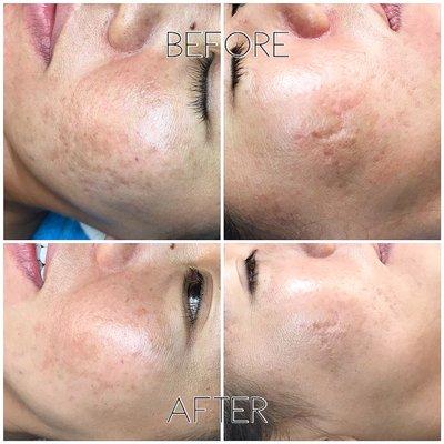 Chemical Peel before/after