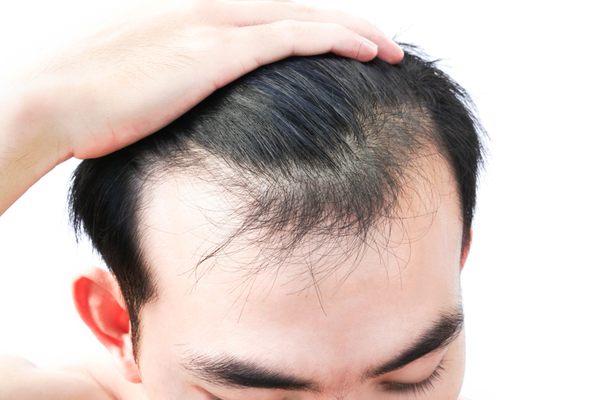 Losing hair?  
PRP is highly effective in stimulating hair regrowth.