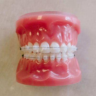 Clear braces