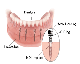 SnapFit Dentures