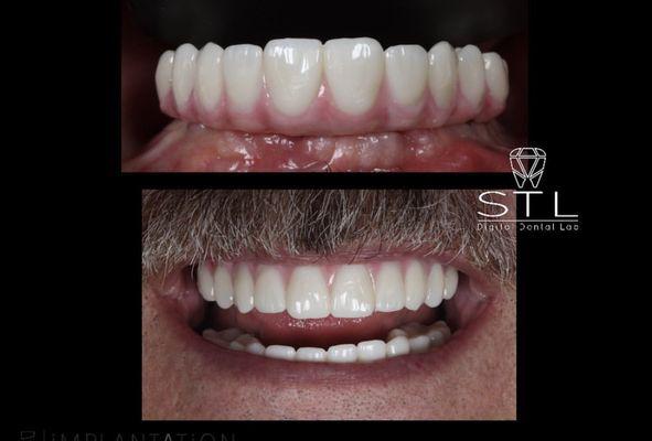 Non removable teeth with 4 to 6 implants - digital work flow - outstanding results