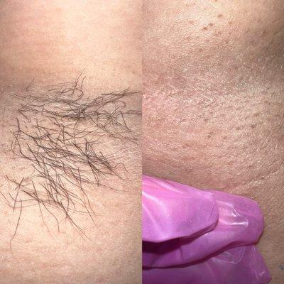 Before & after underarm wax