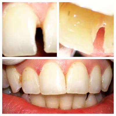 aesthetic tooth colored filling on a front tooth