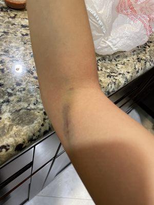 1-2 days after my blood was drawn, the bruising was going up my arm and my injection site was extremely red!