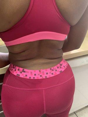 Back fat still present after 360 lipo