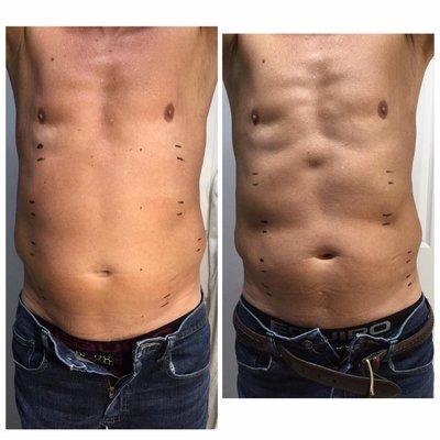 Laser Lipo is for everyone! Even already fit people who want to be cut! Love it!