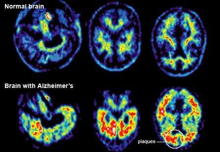 PET/CT for Alzheimer's Evaluation