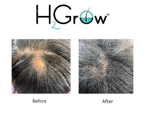 JRS Hair loss Clinic before and after pictures
Complete Ideal Nutrient 90 days results