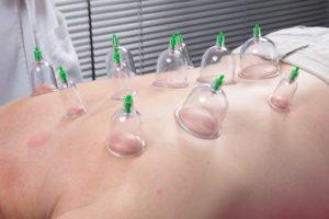 Cupping